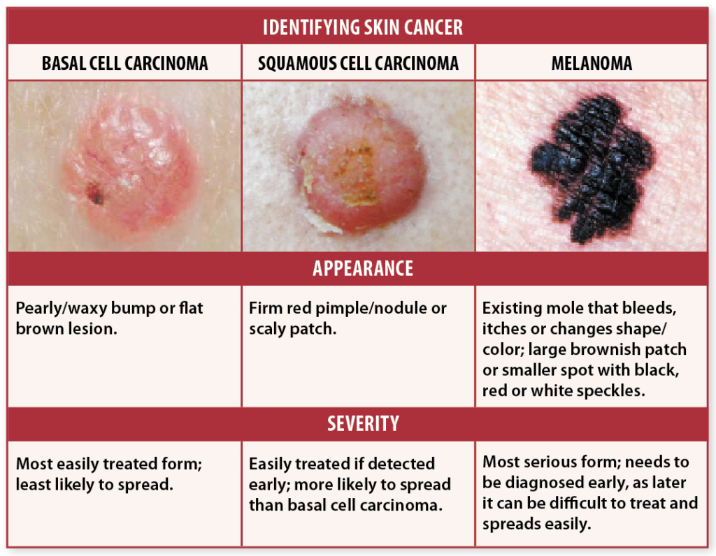 Skin Cancer Picture Chart