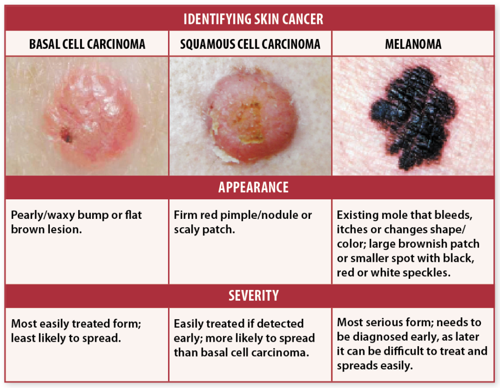 Skin Cancer Chart Pictures